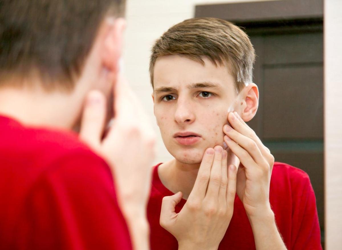  Une nouvelle piste thérapeutique pour traiter l’acné ?