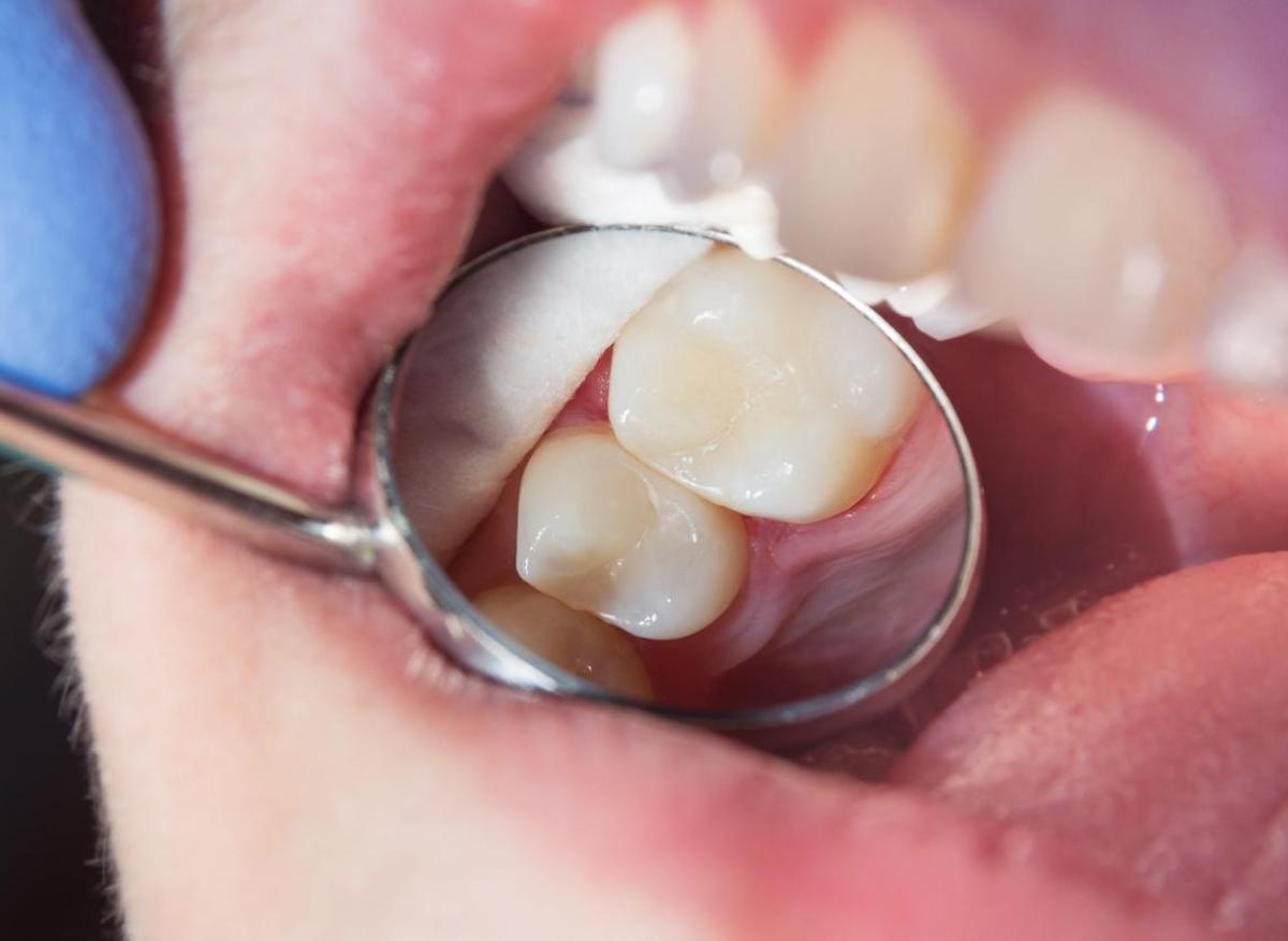 Bientôt un émail biologique pour traiter les caries ?