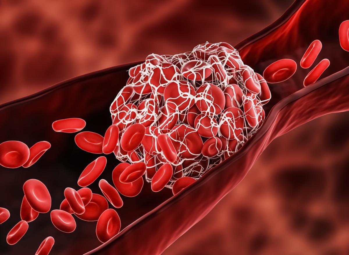 Covid-19 : le risque d’embolie pulmonaire et de thrombose veineuse demeure accru plusieurs mois après l’infection 