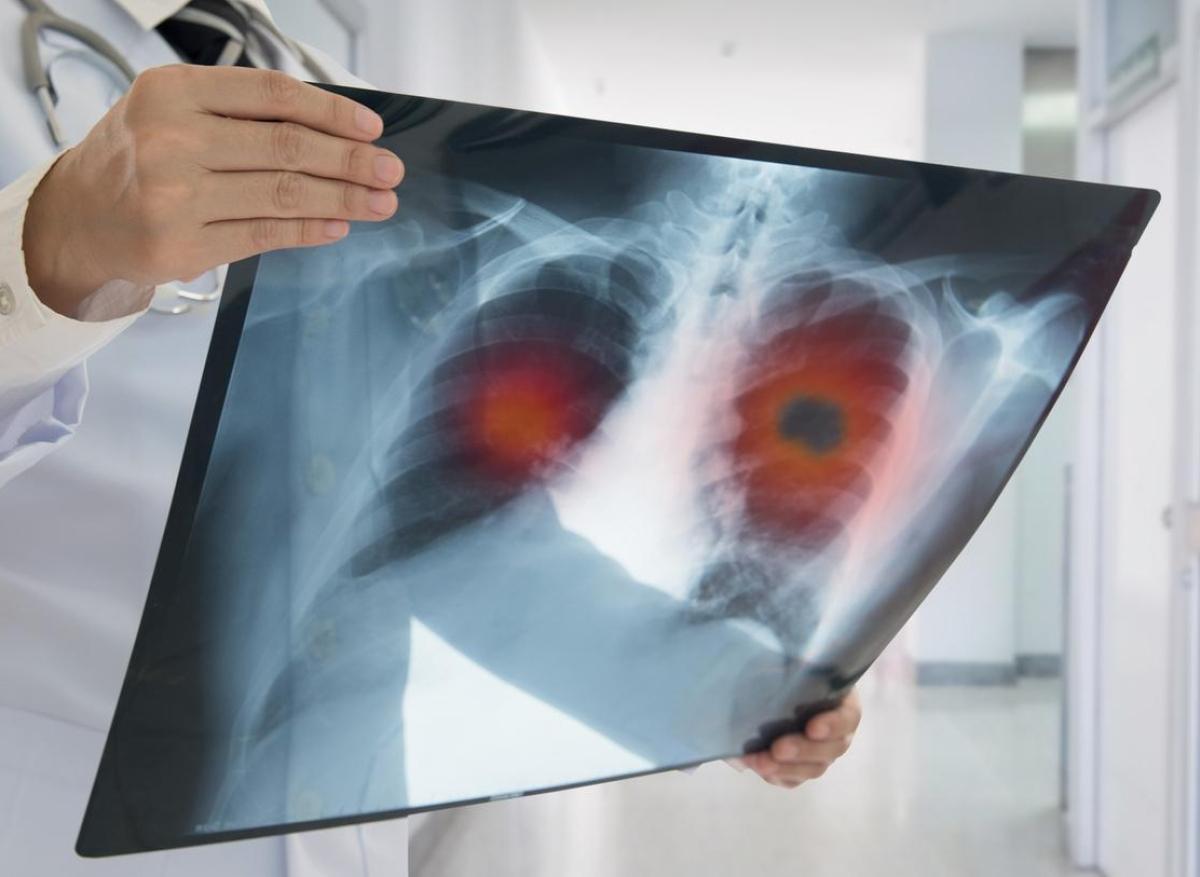 Cancer du poumon : la double greffe réussie est-elle toujours possible ?