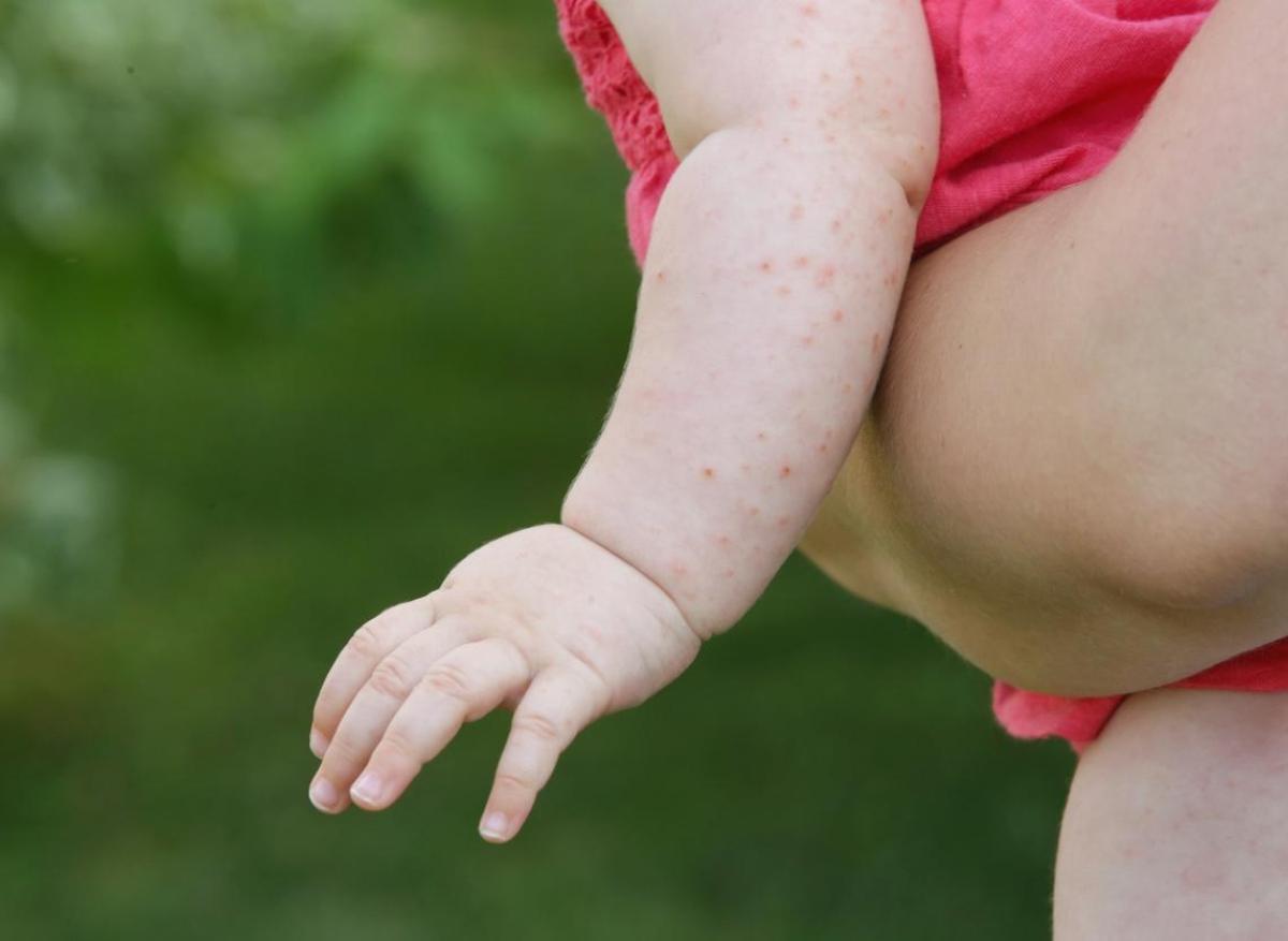 Grippe de la tomate : pourquoi ce nom ?