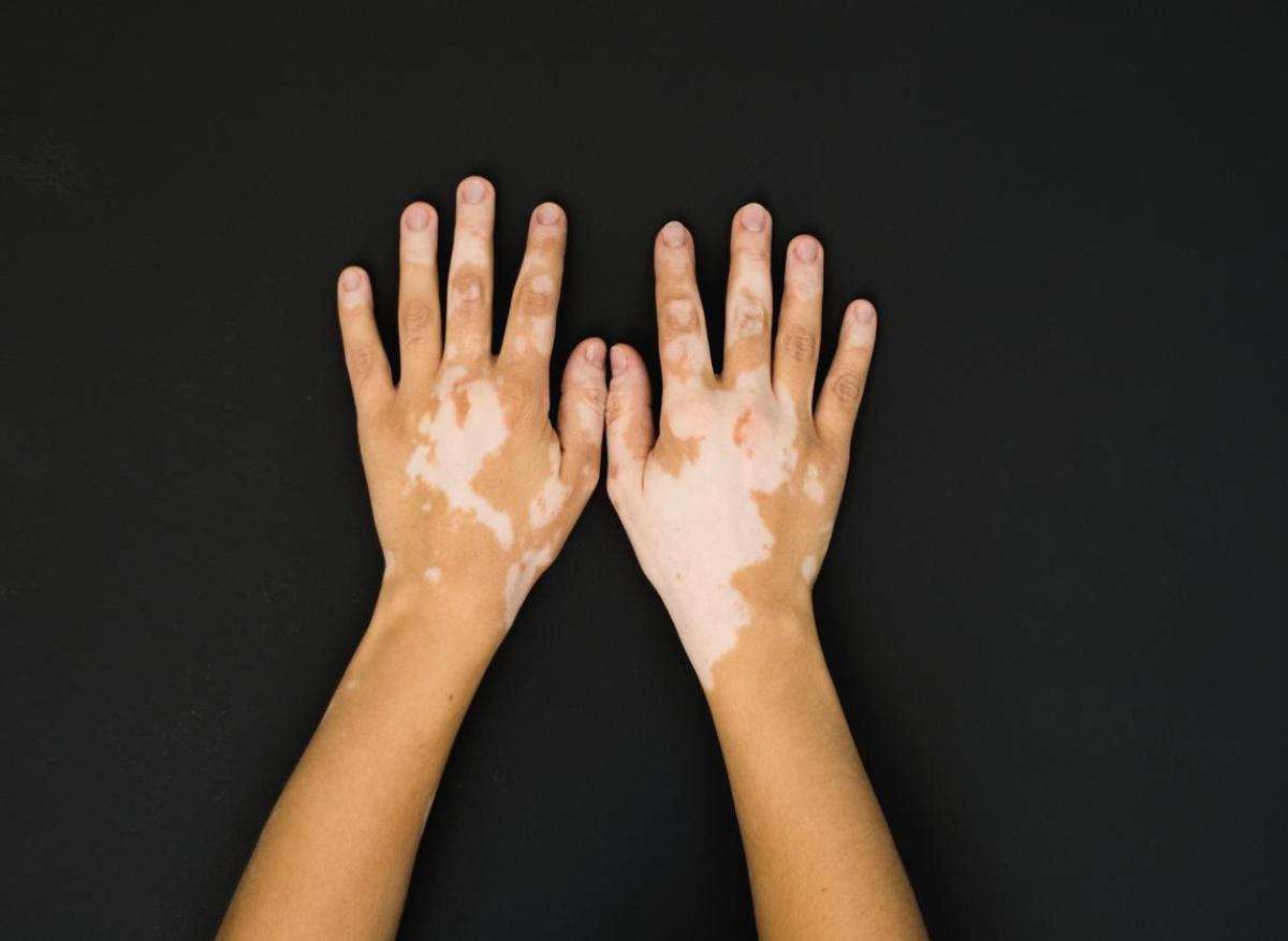 Vitiligo : une maladie bénigne toujours stigmatisée en France