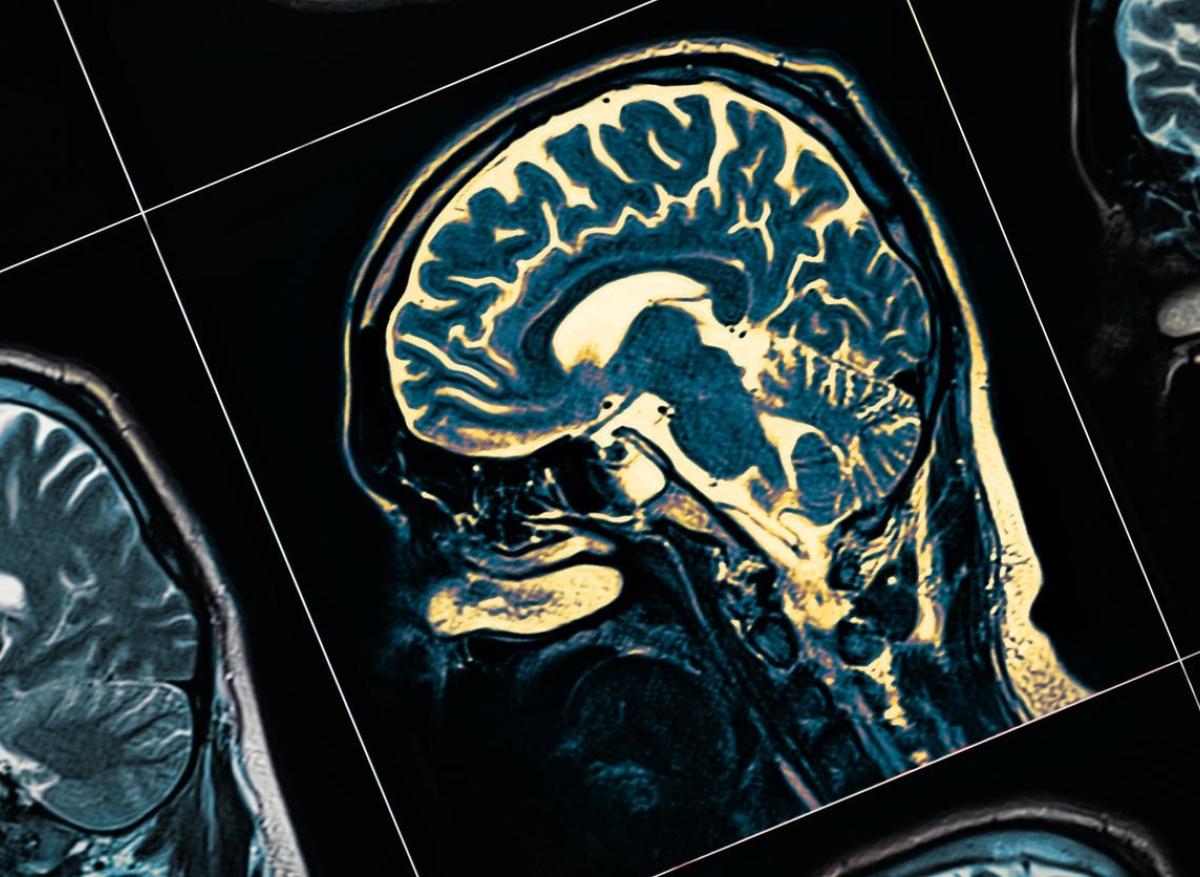 ​​Parkinson : un dispositif qui envoie de la dopamine directement dans le cerveau 