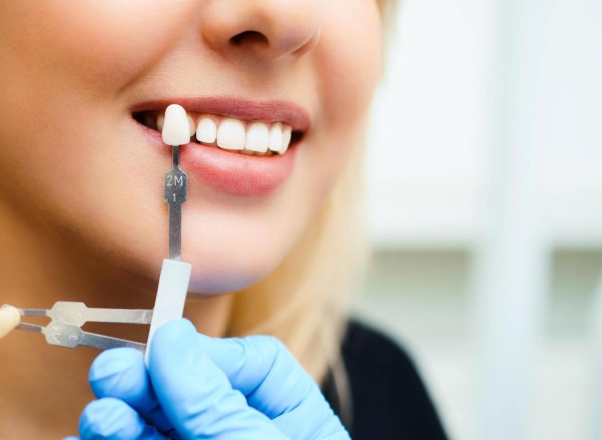Se limer les dents, la tendance qui inquiète les dentistes 