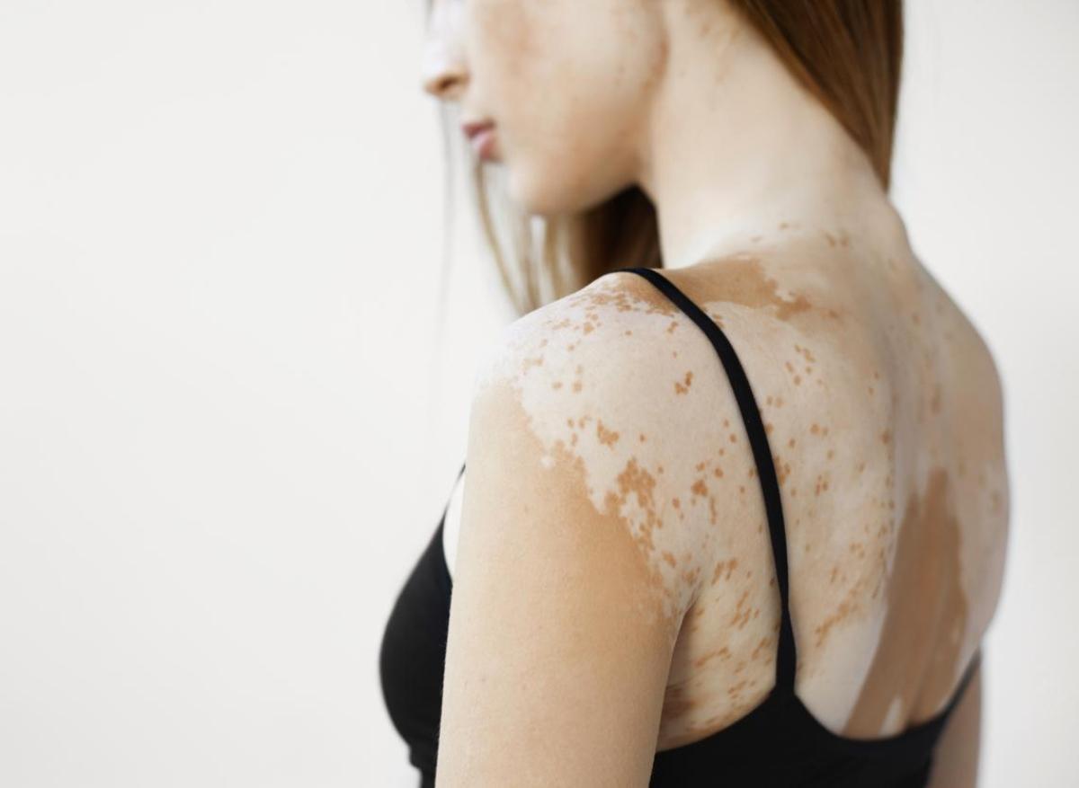 Vitiligo : bientôt un traitement efficace pour repigmenter la peau