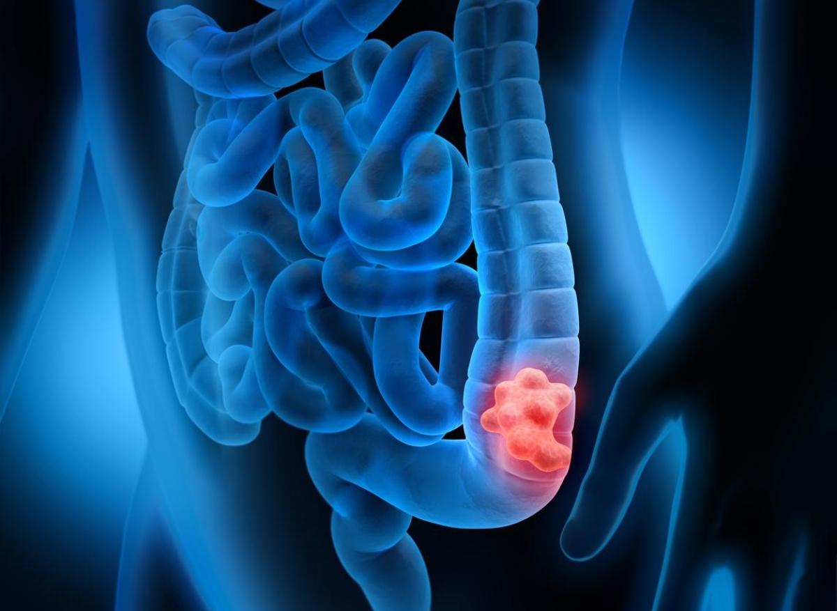 Cancer colorectal : quels sont les signes? 