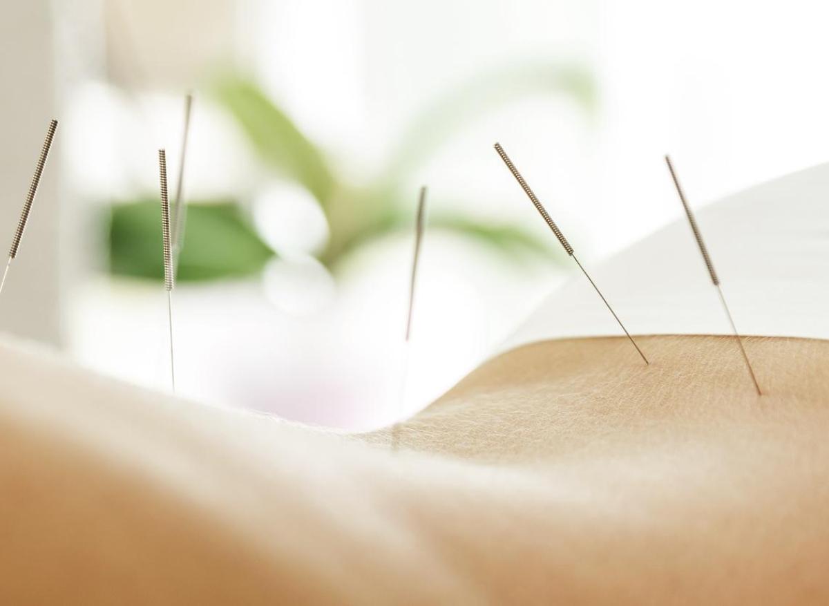 Aphasie motrice post-AVC : l'acupuncture peut réduire les symptômes  