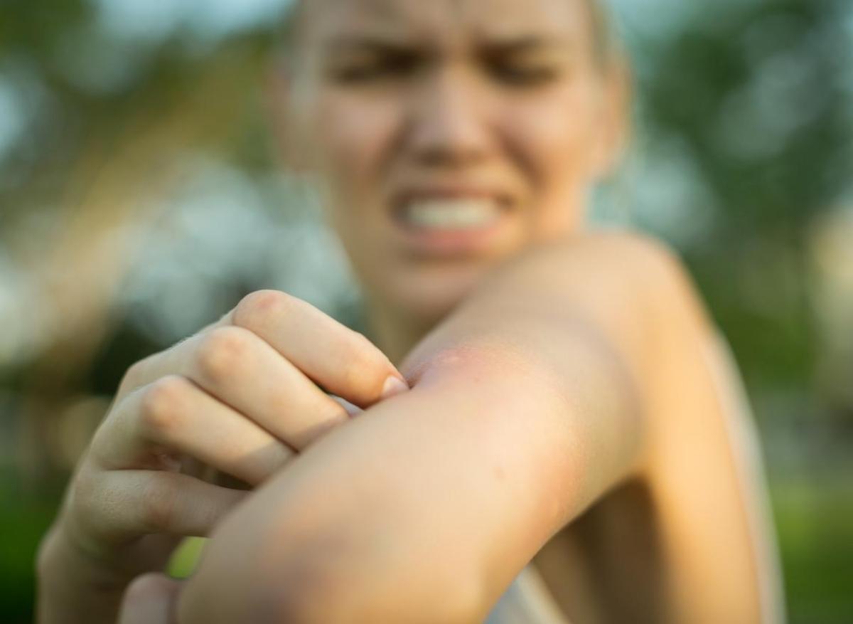 Comment apaiser la peau après les piqûres de moustiques ? 