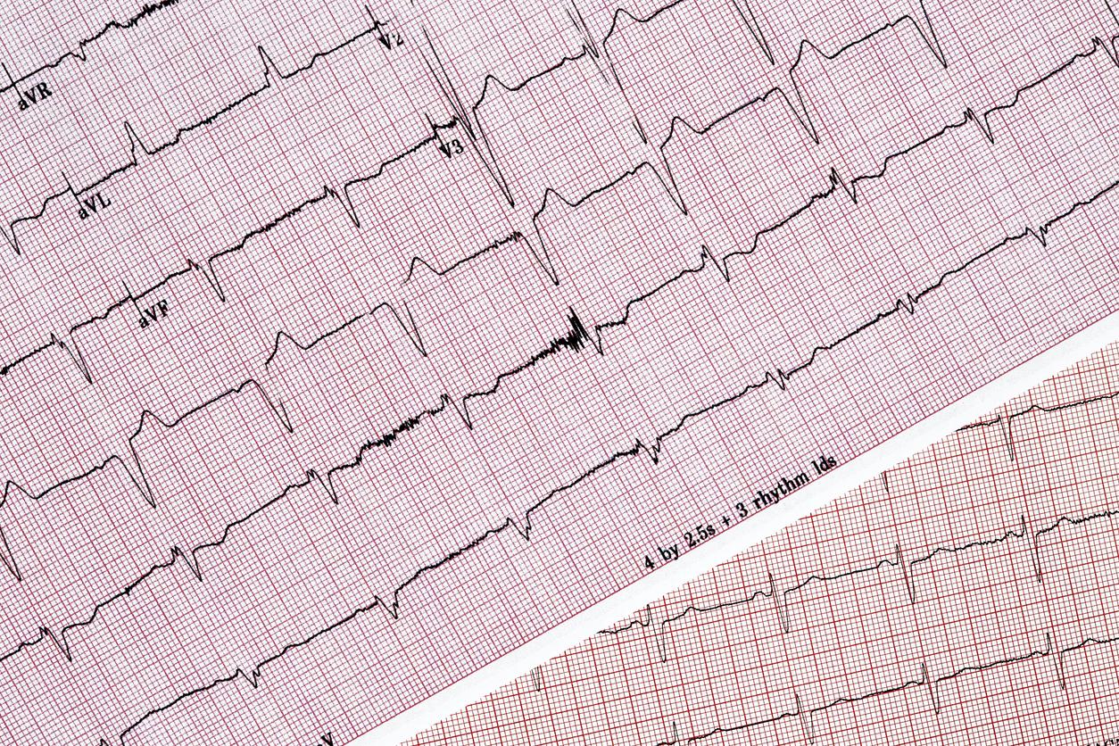 Dépistage de la fibrillation atriale en officine : l’exemple girondin 