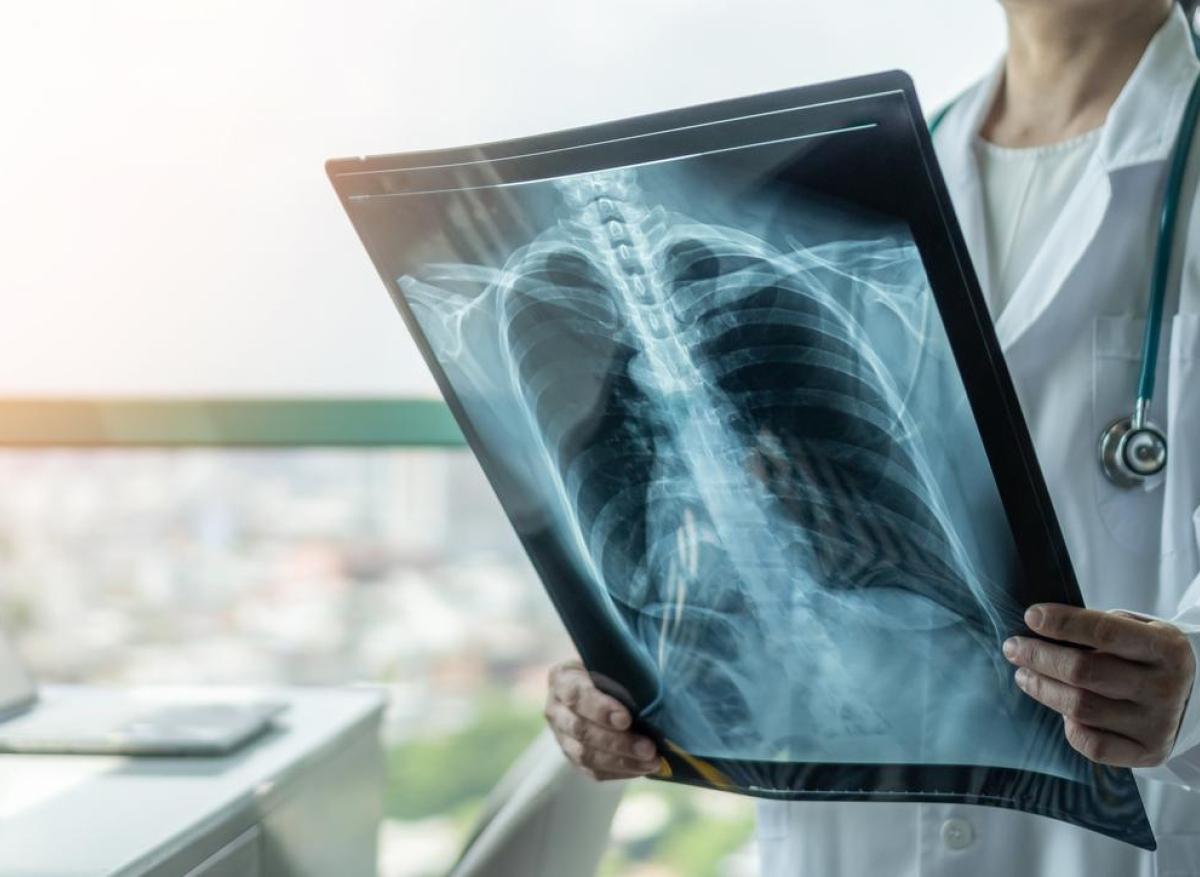 Covid-19 : les complications graves peuvent endommager le tissu pulmonaire