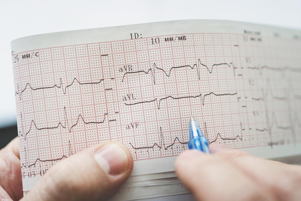 Tachycardie atriale : pas de d’anticoagulants systématiques en prévention des AVC