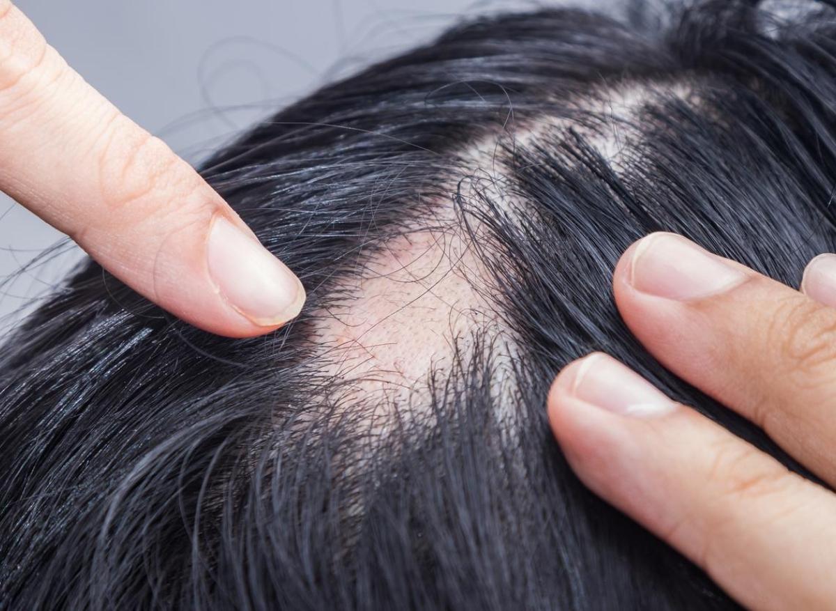 Alopécie : un nouveau traitement favoriserait la repousse des cheveux