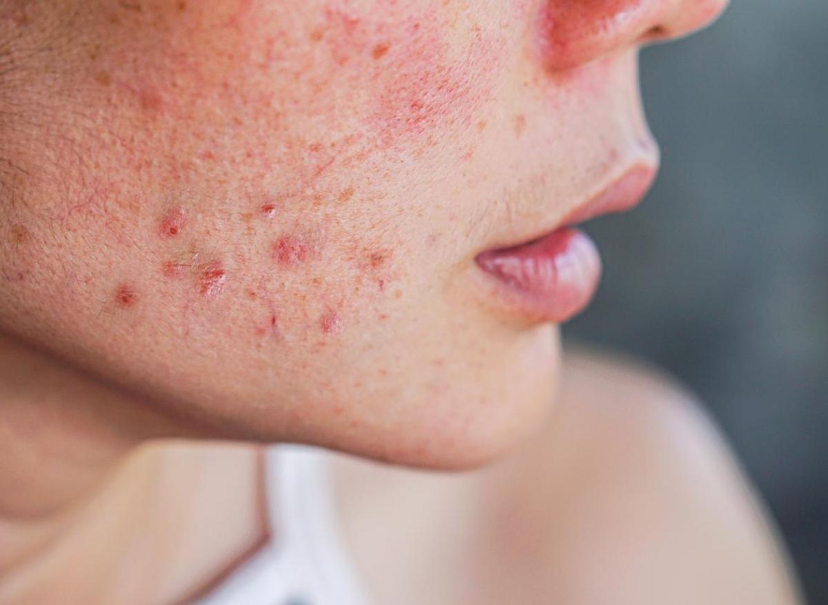 Acné : les dermatologues émettent de nouvelles recommandations pour la prescription d’Isotrétinoïne (Roaccutane)