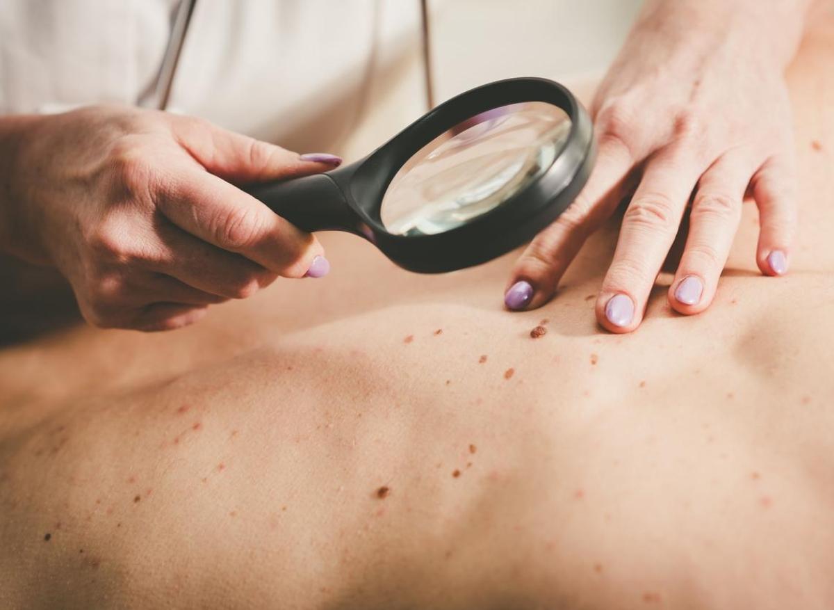 Comment détecter un cancer de la peau ? 