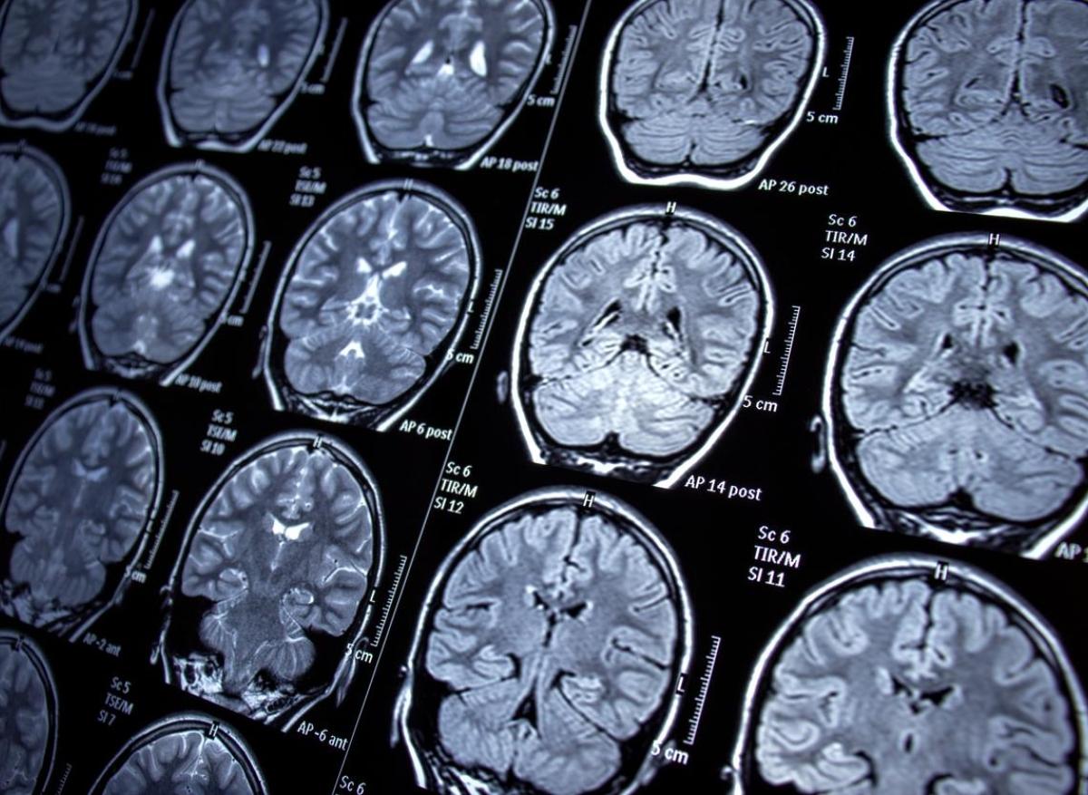 Un réseau cérébral commun à six maladies psychiatriques a été identifié