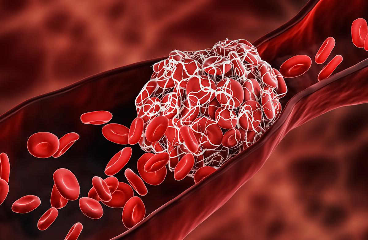 Peu de différences entre anticoagulants directs dans la thrombose veineuse profonde