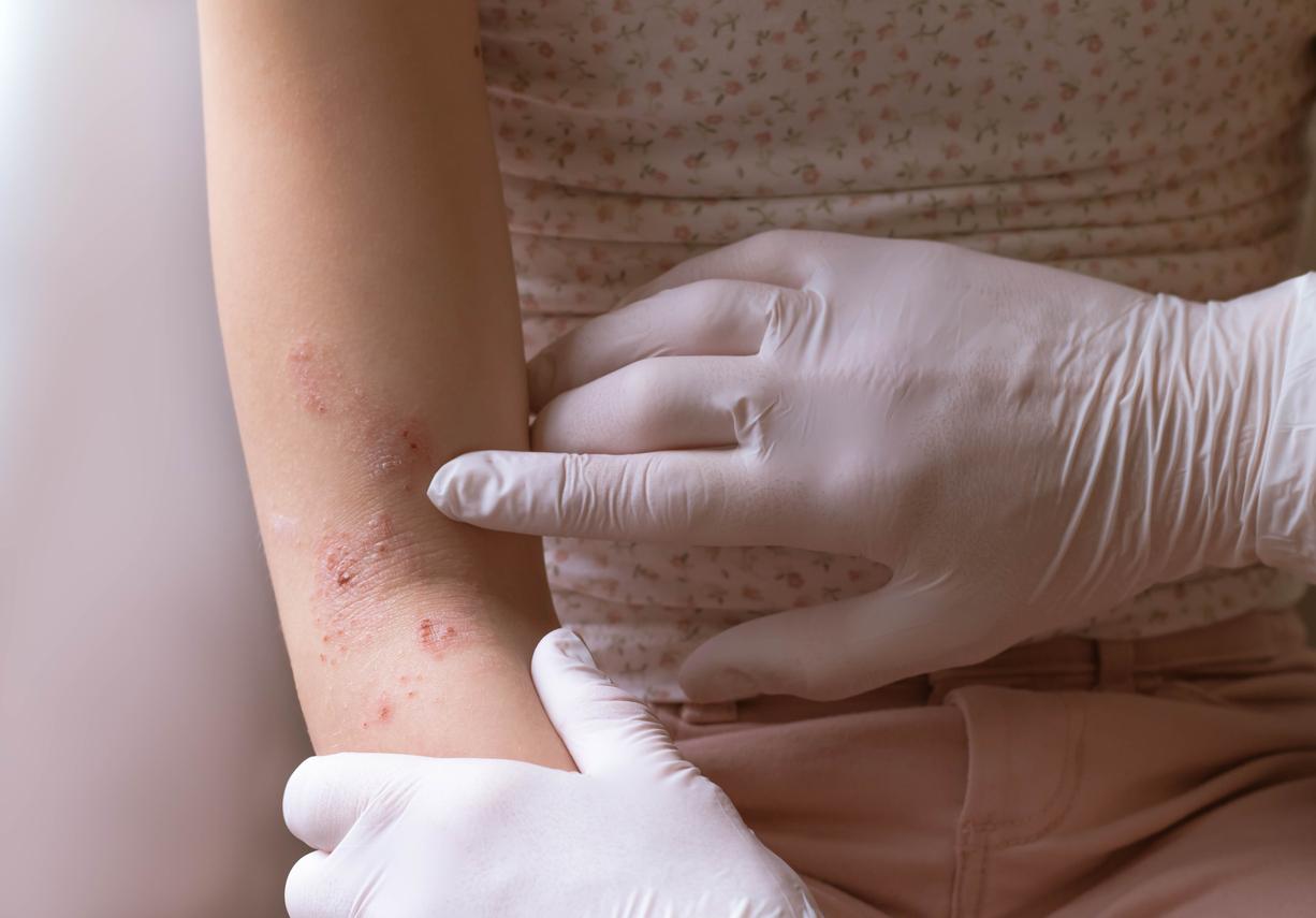 Nouveau traitement pour la dermatite atopique