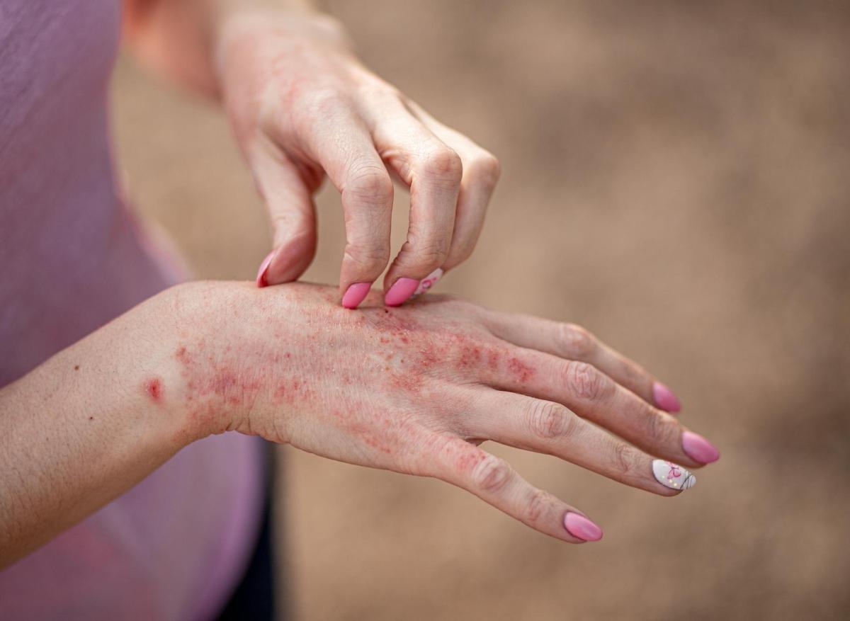 Psoriasis : certains lipides pourraient exacerber les douleurs