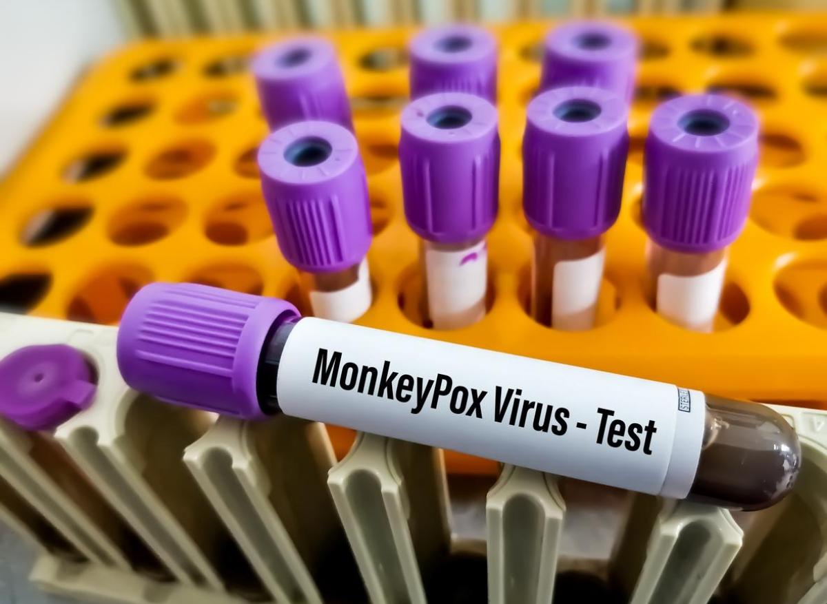 Variole du singe : les tests de dépistage remboursés à 100 % 
