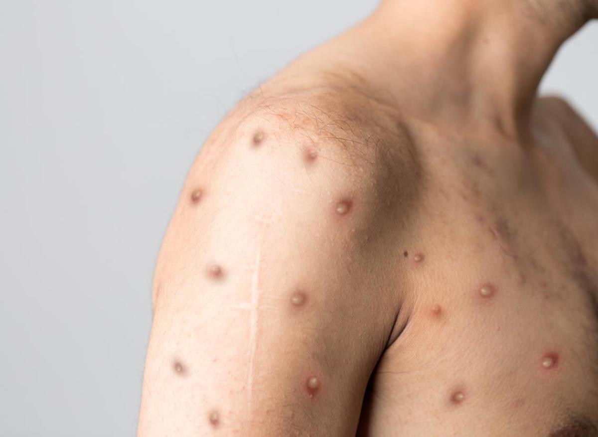 La variole du singe pourrait entraîner l'encéphalite, de la confusion ou des convulsions chez certains patients
