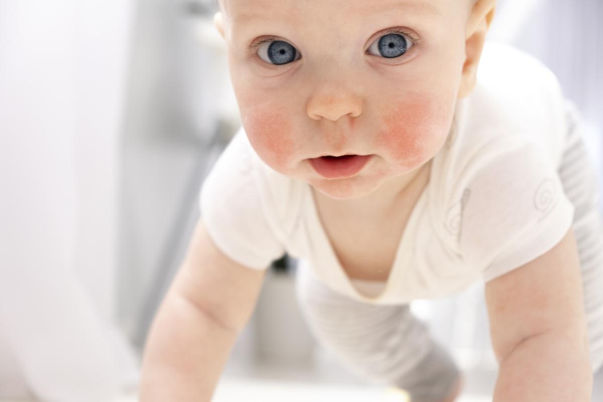 Allergies : les différences d’incidences entre la ville et la campagne expliquées