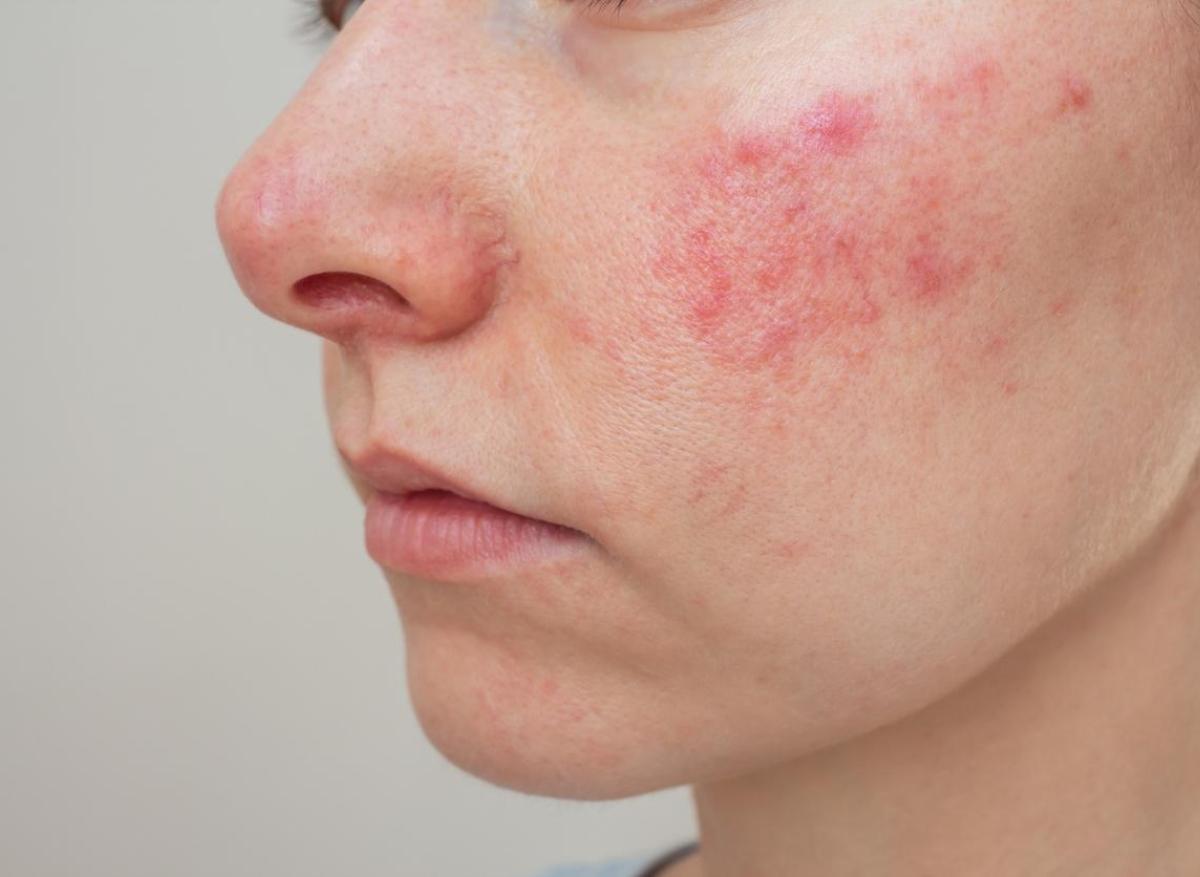 Rosacée : les conseils d’une dermatologue pour la réduire 