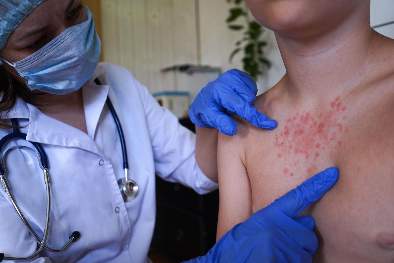 Rougeole : Santé publique France appelle à renforcer le rattrapage vaccinal