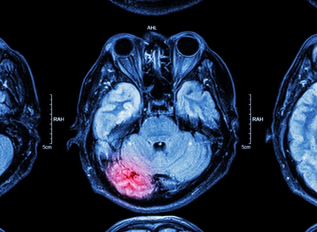 Gliome : les traumatismes crâniens pourraient être un facteur de risque