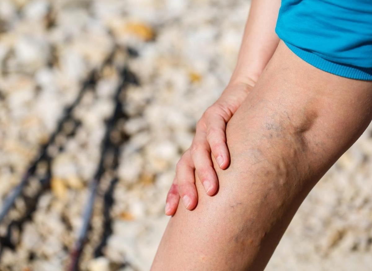 Varices des jambes : ces symptômes à ne pas négliger 