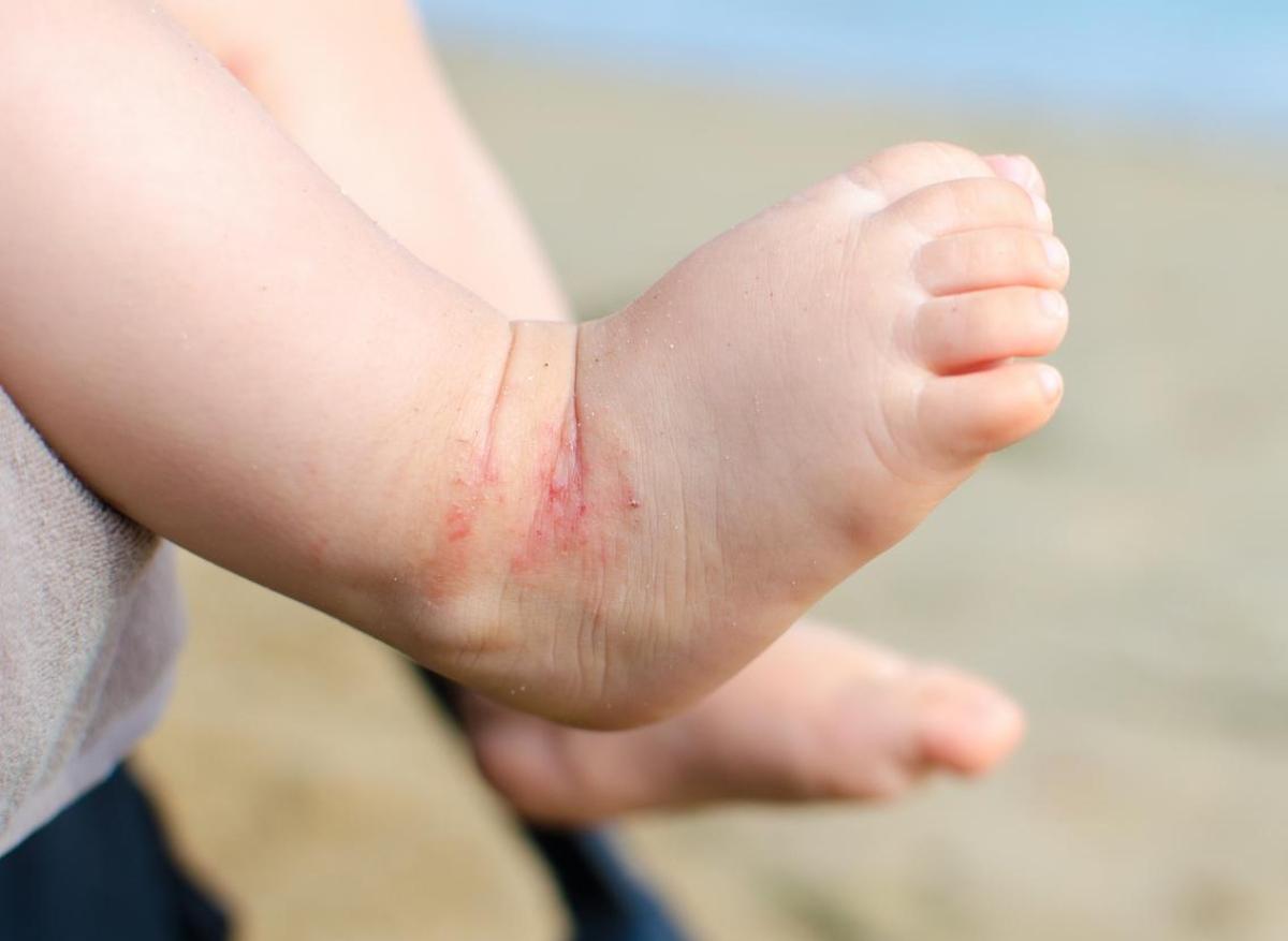 Dermatite atopique : elle augmenterait le risque de fractures chez l'enfant