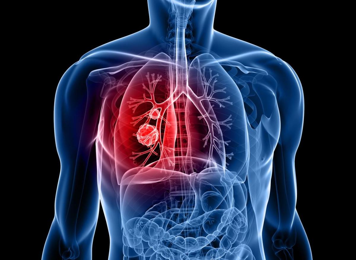 Tumeur du poumon : une technique d’ablation non-chirurgicale utilisée en France