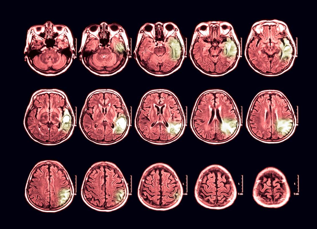 Acétate de cyprotérone : nette réduction du risque de méningiome depuis 2018